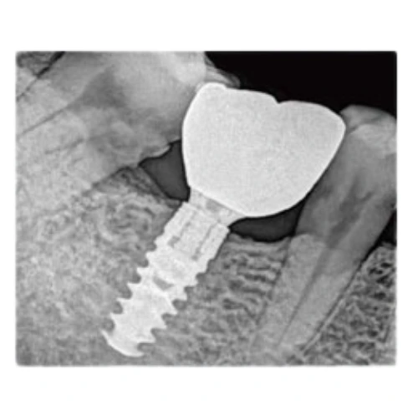 Xpect Vision RVG Sensor for Digital Dental X-Ray Imaging – Size 1.5 - Image 9